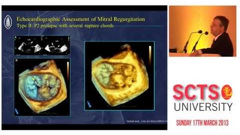Mitral valve echocardiographic assessment