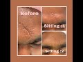 Bonitaa skin and hair care  scar treatment  scar reversal