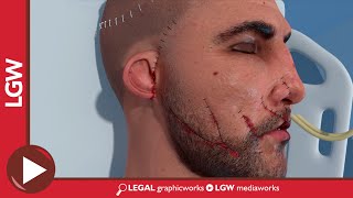 Facial Soft Tissue Close Surgery 3D animation screenshot 3