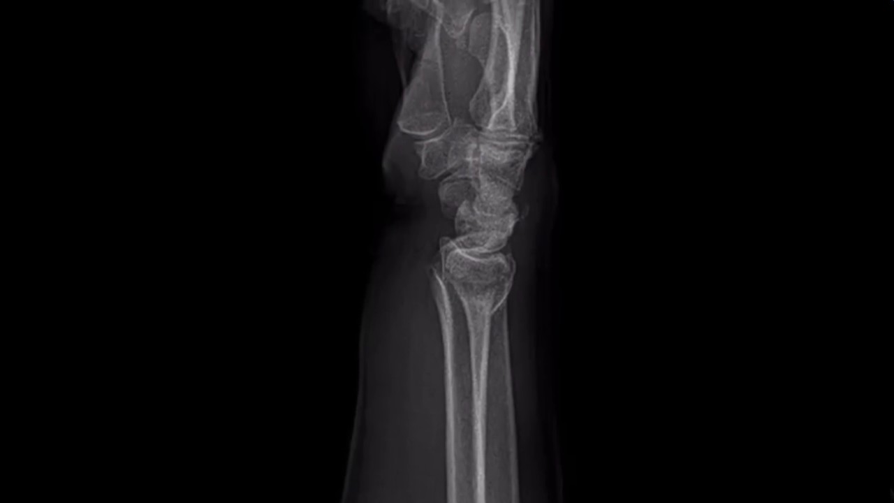 Distal Radius Reduction with Ultrasound YouTube