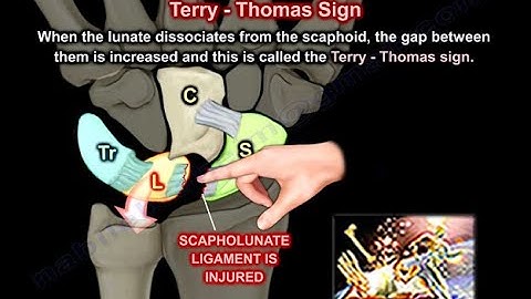 Perilunate & Lunate Dislocation - Everything You Need To Know - Dr. Nabil Ebraheim