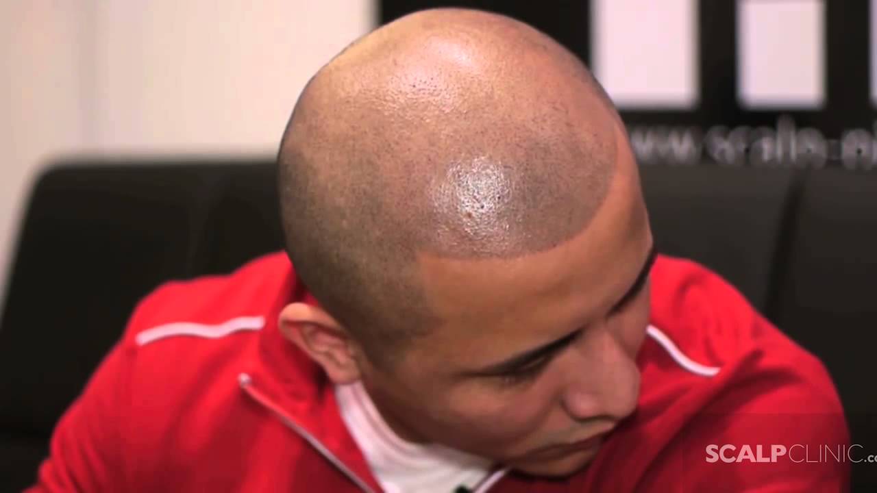 New York Scalp Micropigmentation Scalp Clinic for Hair Loss YouTube