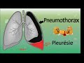  pneumothorax  pleursie   cours  pneumophtisiologie