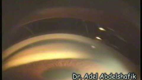 Ophthalmolgy- Test yourself: gonioscopy 01