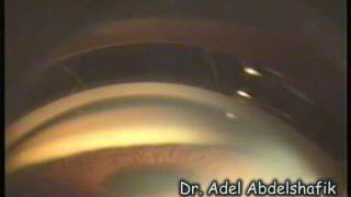 Ophthalmolgy- Test yourself: gonioscopy 01
