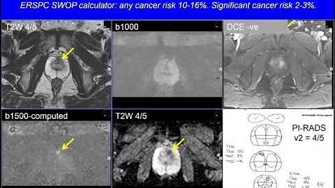 Risk based mpMRI prostate diagnosis