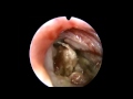 Endoscopic foreign body removal from skull base.