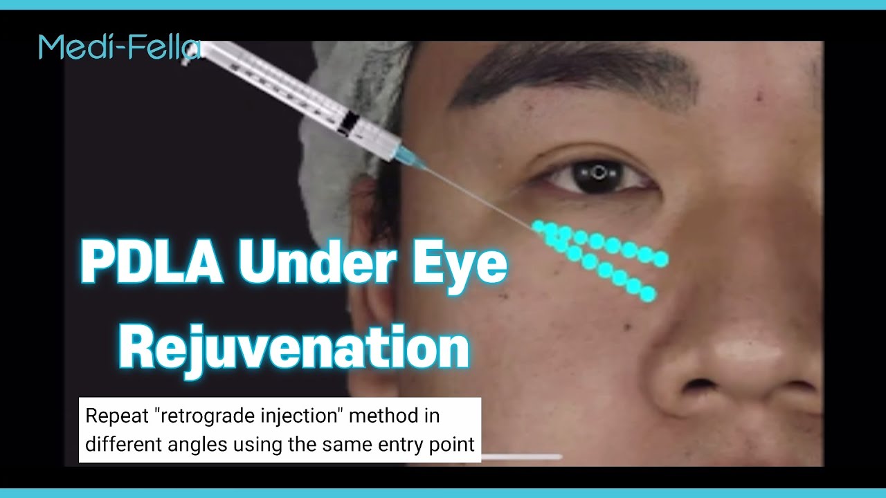 PDLA for Under Eye Rejuvenation