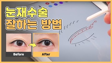 눈재수술 잘하는 병원은 어떤 방법으로 쌍꺼풀재수술을 진행할까? #눈재수술잘하는곳 #쌍꺼풀재수술병원