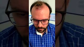 Transplante capilar - Antes e depois.