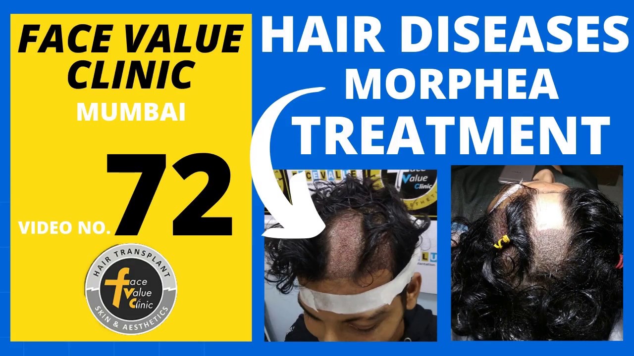 Patient From Hyderabad Came For Hair Transplant !! Amazing Results