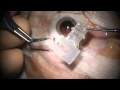 Chirurgie de la cataracte avec implantation mutifocale par le docteur dominique pietrini