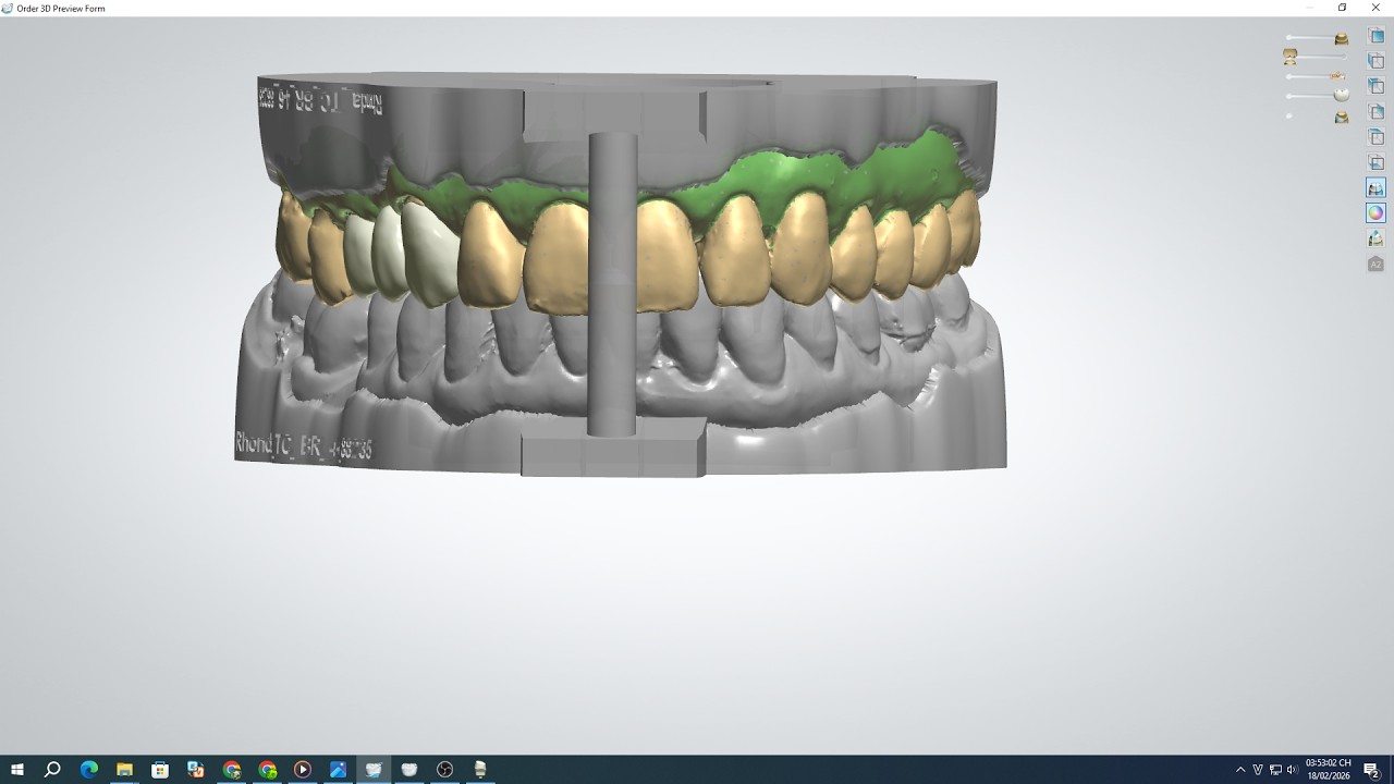 Designing Ceramic Crowns Using 3Shape Software _Thiết Kế Răng Sứ Trên ...