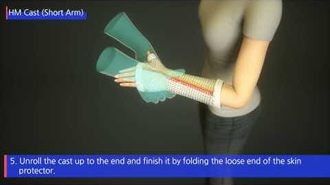 HM CAST Short Arm (3D Procedure)