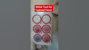 Widal Test for Typhoid and Paratyphoid Fever | Salmonella Agglutination Test