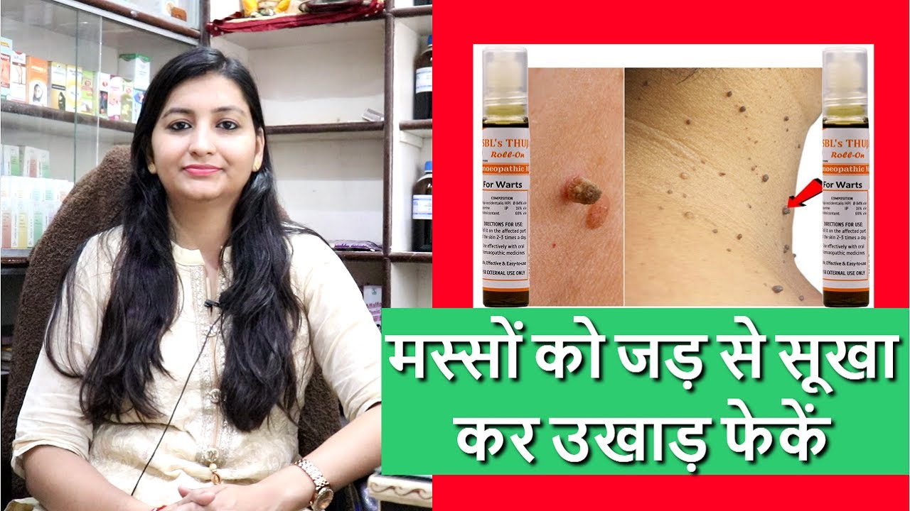 मस्से को जड़ से ख़त्म करने का सबसे अच्छा इलाज Masse ka ilaj Warts ka ilaj Thuja Rollon
