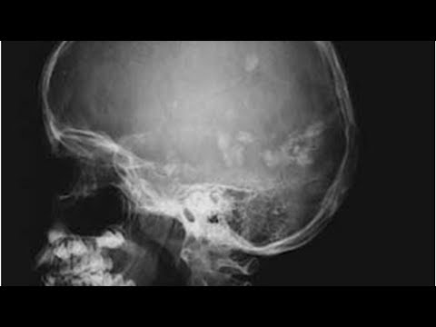 Wideo: Złamanie Podstawy Kości Czaszki - Objawy, Przeżycie, Następstwa I Leczenie Złamania Czaszki