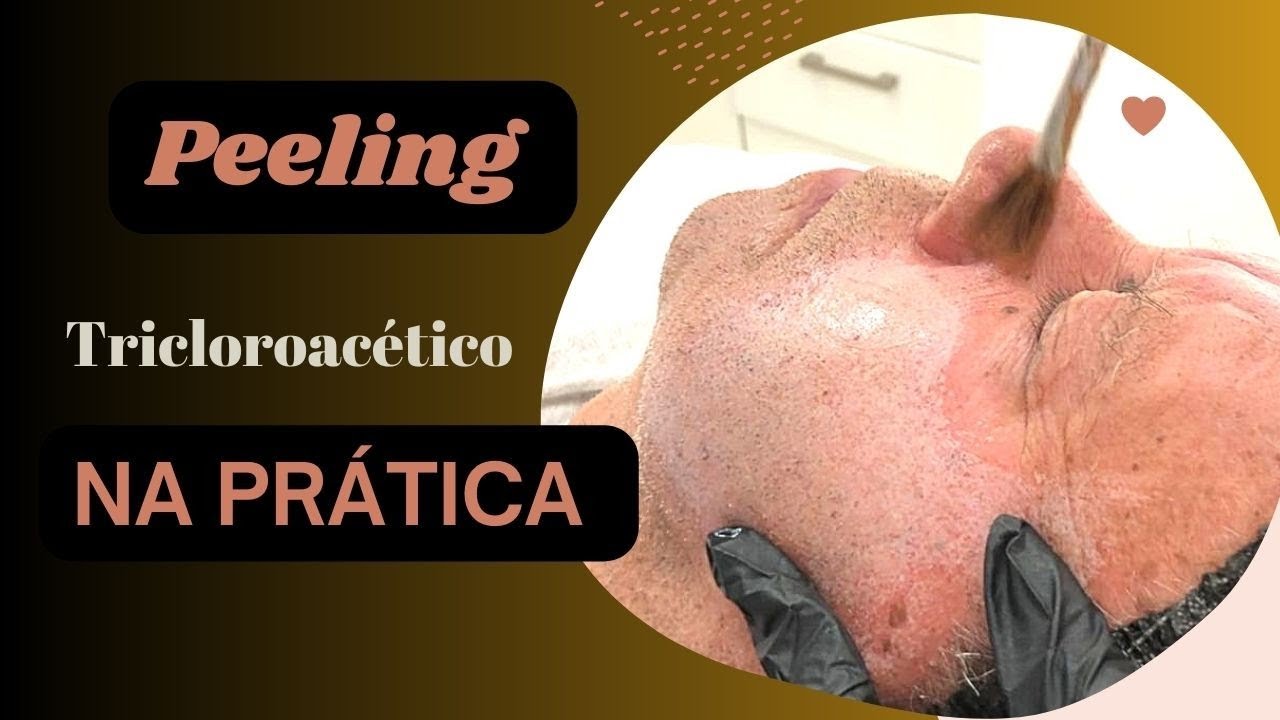 COMO É FEITO O PEELING DE ÁCIDO TRICLOROACÉTICO? | NA PRÁTICA| ÁCIDO ...