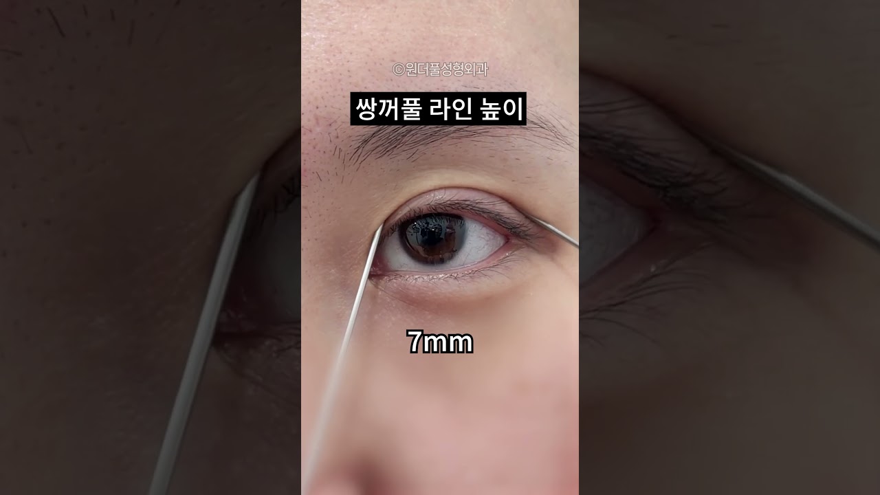 Гайхамшигт гоо сайхны мэс заслын эмнэлэг давхар зовхины шугамын өндөр