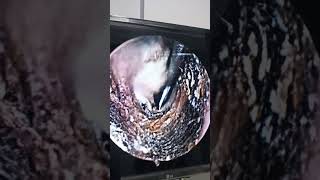 Doctor Uses Endoscope for Deep Ear Cleaning 👨‍⚕️👂 #ASMR #EarCare
