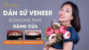 Dán sứ veneer đóng khe thưa răng cửa có hiệu quả?