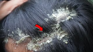 Dandruff Removal, Itchy Dry Scalp, Huge Flakes, Psoriasis Treatment and Scratching #311