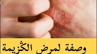 لاي واحد كيعاني من الݣزيمة وملقاش ليها الحل هذه الوصفة الطبيعة التي توجد بكل بيت هي الحل