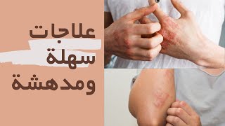 حساسية الجلد / علاجات منزلية وعلاج بالاعشاب