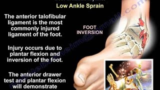 Foot and Ankle Injuries and fractures - Everything You Need To Know - Dr. Nabil Ebraheim