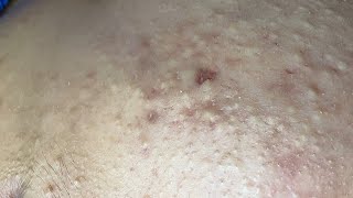 Inflammatory Acne P2 (Minh) | Mụn Viêm Tụ Máu P2 (Minh) - SacDepSpa#344