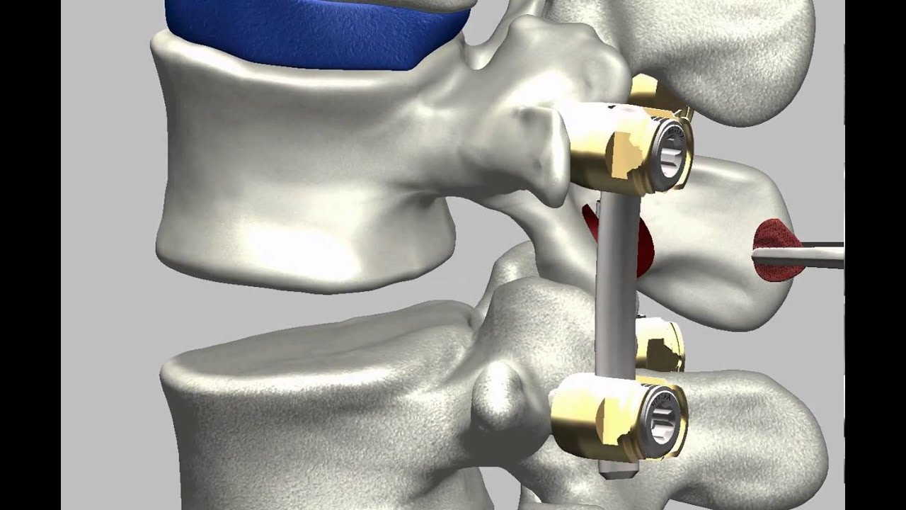 ADONIS PLIF Caja lumbar