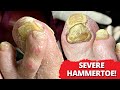 Does This Hammertoe Need Surgery? 🧐 (Satisfying Toenail Cutting)