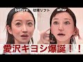 とあるキャバ嬢が切開フェイスリフトとネックリフトやったら愛沢キヨシが爆誕した件