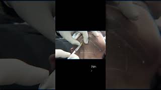 Double Chin Reduction with Botox in Vesu Surat | Non-Surgical Jawline Contouring #dermatologistsurat