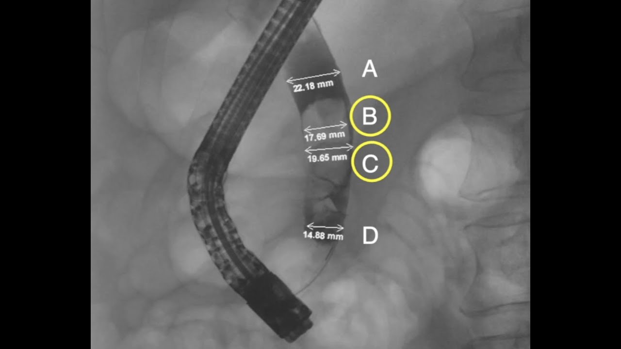 ERCP Masterclass Orlando Protocol for Management of Bile Duct Stones