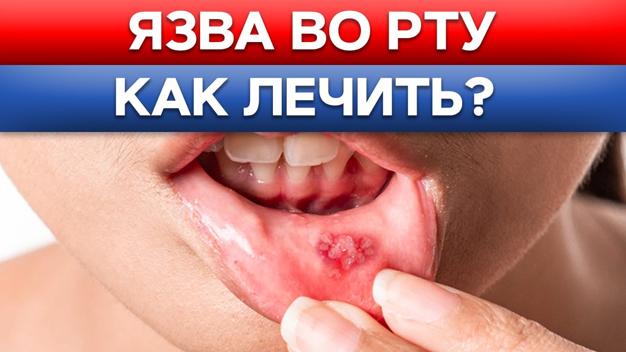 Главная причина болезней ДЁСЕН! Лечим кровоточивость и воспаление десны ...