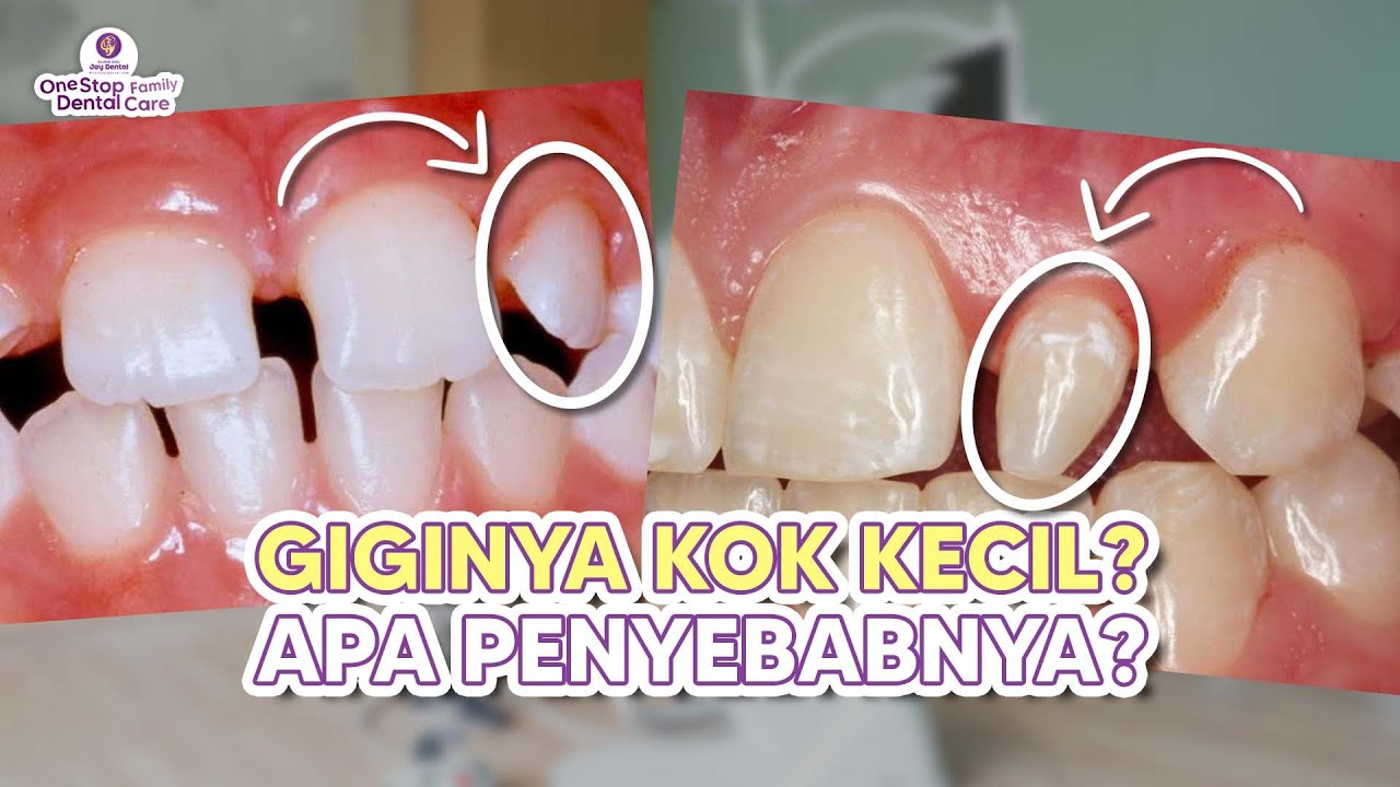MICRODONTIA!! Kelainan ukuran gigi yang lebih kecil dari biasanya!