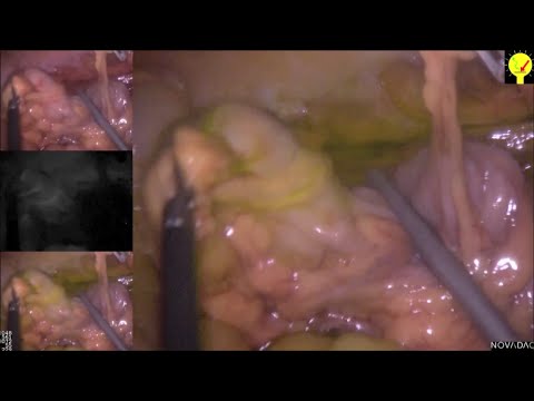 Avoidance Of Ischemia At Proximal Colonic Transection During TME Using Near-infrared Fluorescence