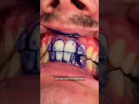 Vídeo: O dentista clareia seus dentes?