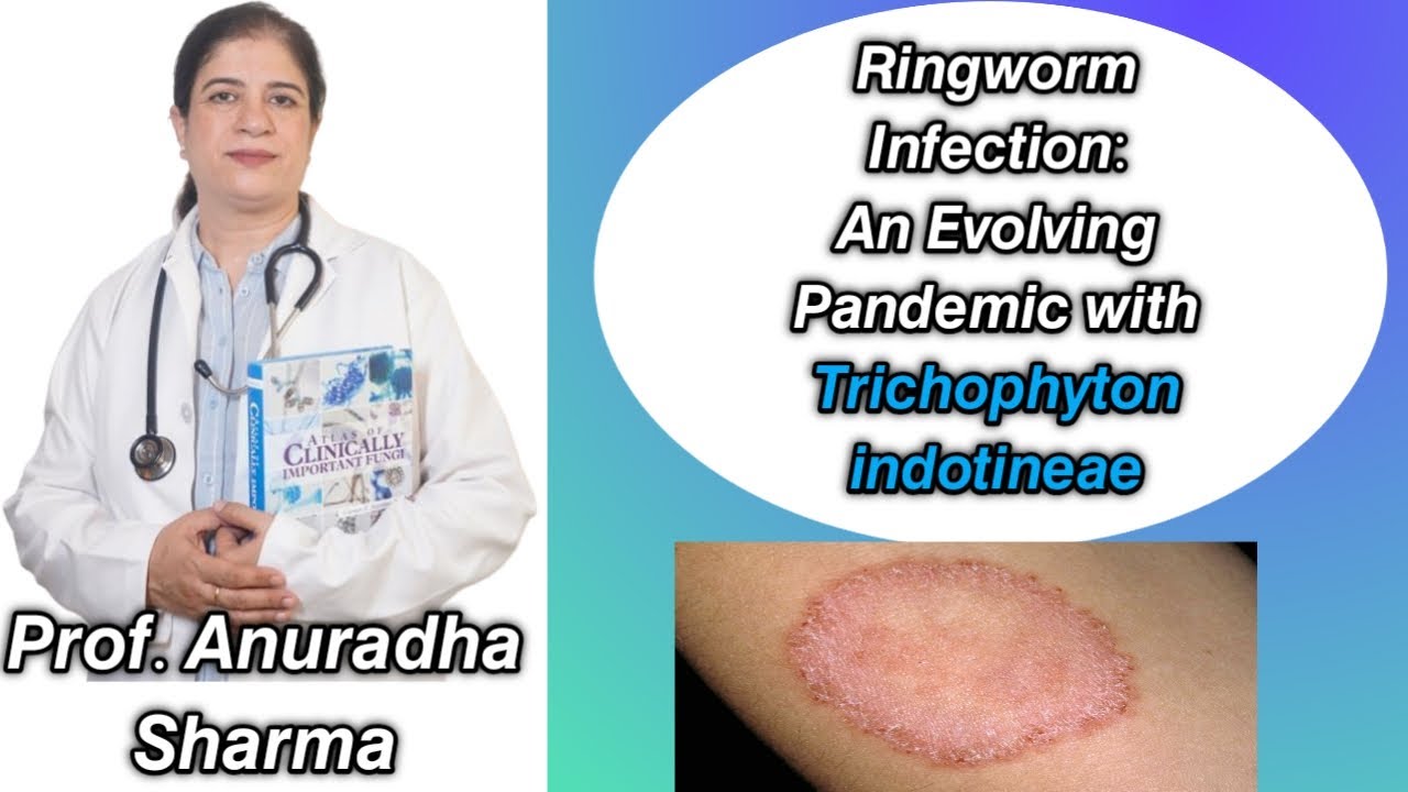 Ringworm infections An evolving pandemic Steroid cream misuse side effect Drug resistant