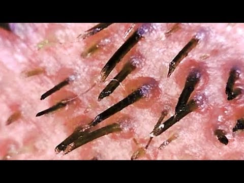 Blackheads and Whiteheads on Face!  Nose Pimples