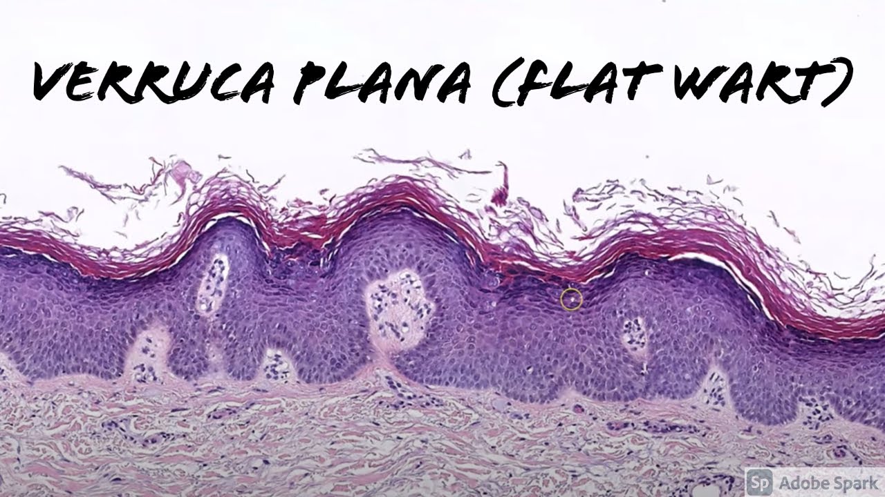 Verruca Plana (Flat Wart under the microscope) 5Minute Pathology
