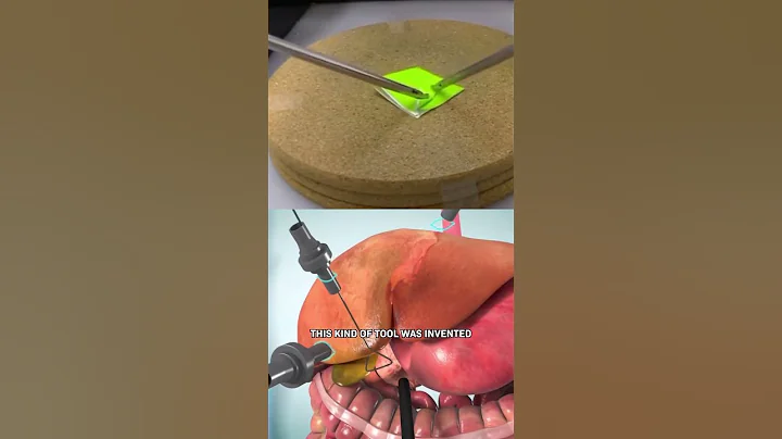 How Laparoscopic Surgery Works