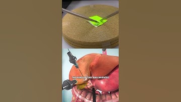 How Laparoscopic Surgery Works