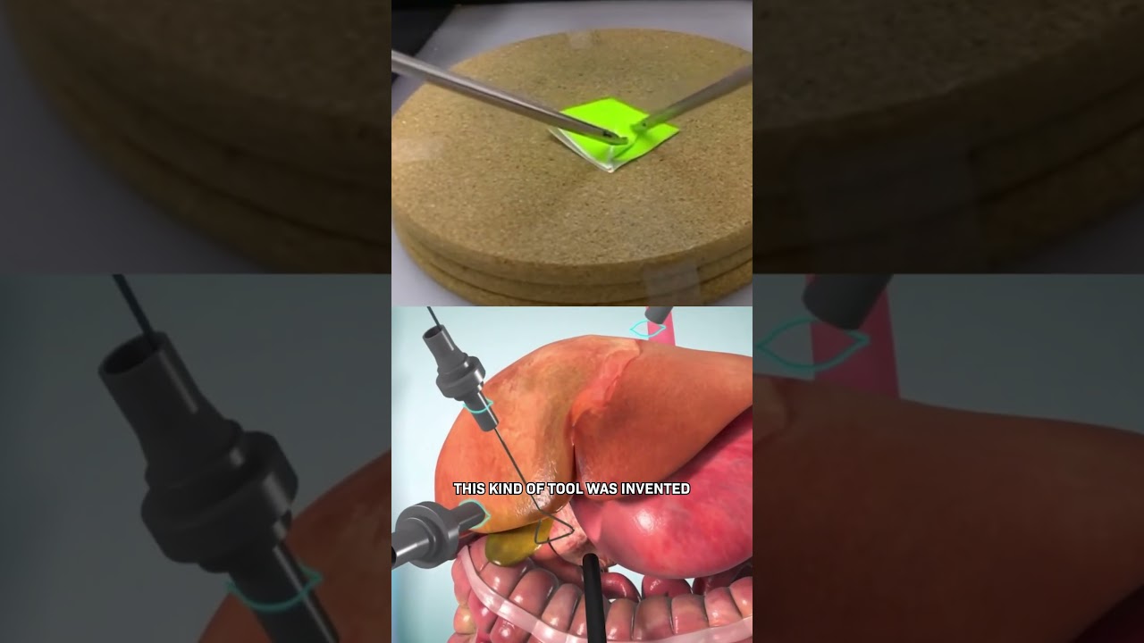 How Laparoscopic Surgery Works 썸네일