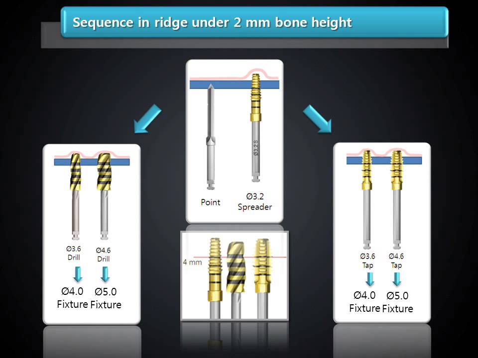Sinus lift kit introduction youtube