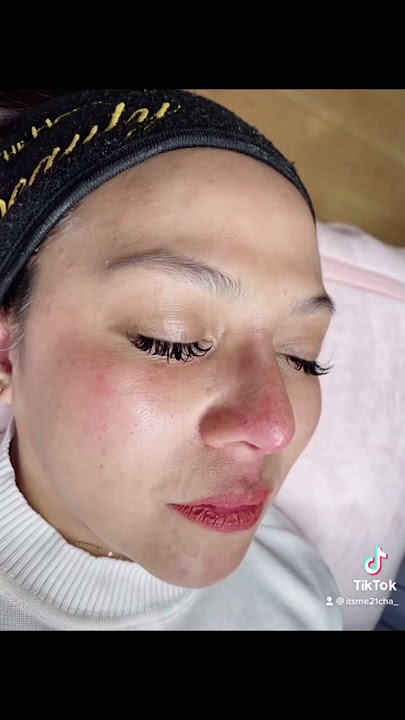 Hiko Nose Threadlift  in Japan🇯🇵.   #hikonosethreadlift #beautyvlog #nonsurgical #rhinoplasty