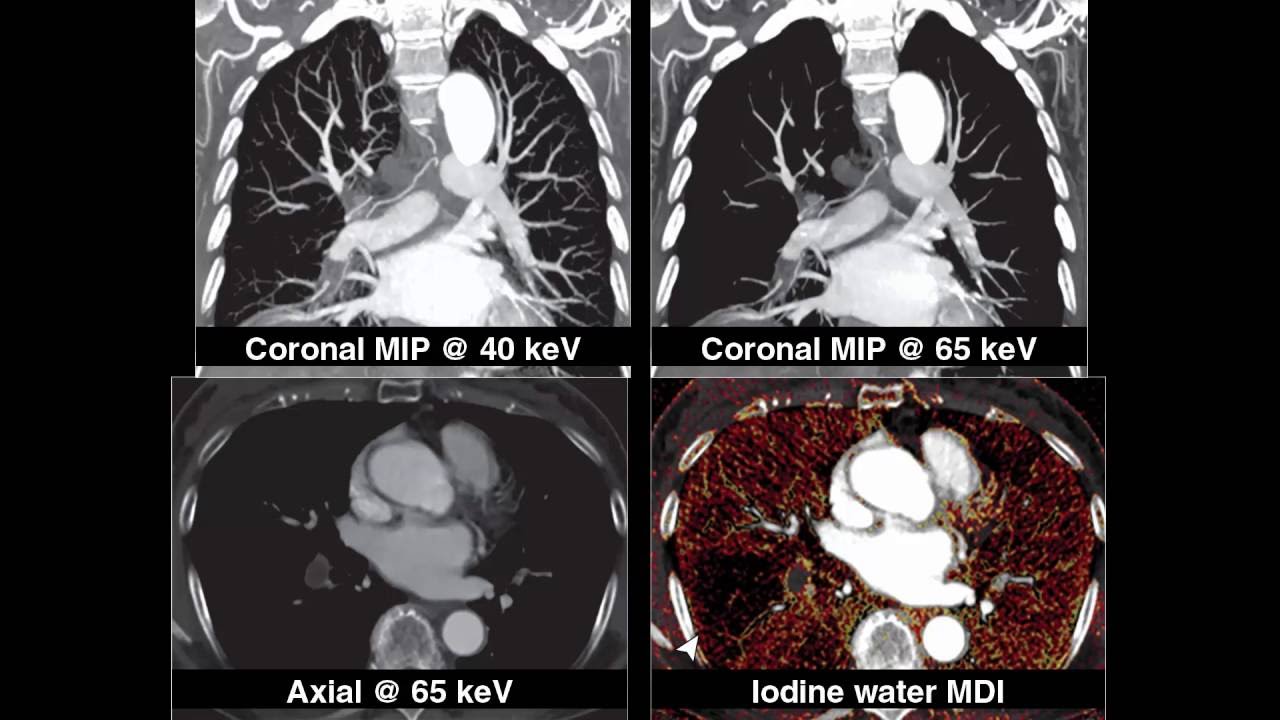 Dual-Energy Spectral CT: Various Clinical Vascular Applications - YouTube
