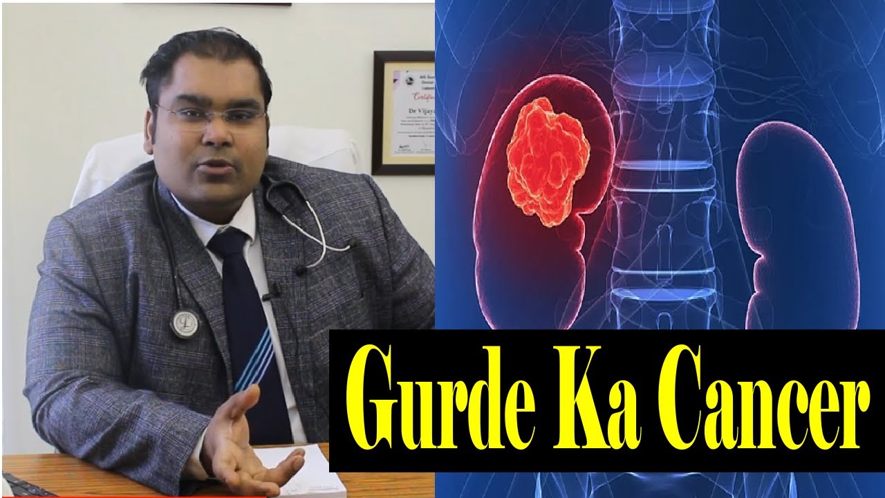 Gurde Ka Cancer ka Ilaj | Kidney Cancer Treatment in Hindi