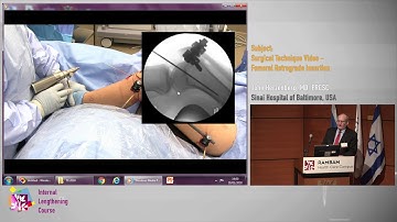 10 Surgical Technique Video - Femoral Retrograde Insertion - John Herzenberg MD. FRCSC